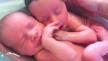 povezanost blizanaca u maternici nastavlja se i nakon poroda