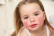 alergije na hranu kod djece