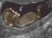 fetus u maternici