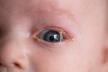 Ljepljive oči beba.jpg