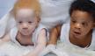 Kako danas izgledaju crni i albino blizanci?