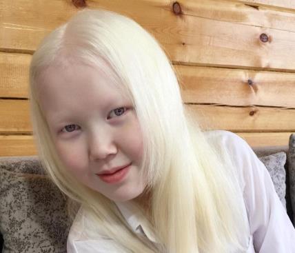 albino djevojčica nariyana