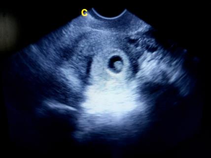 ultrazvuk embrio 6 tjedana