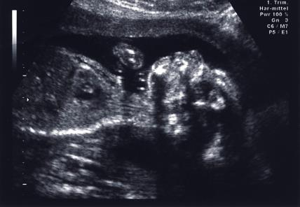 ultrazvuk fetusa