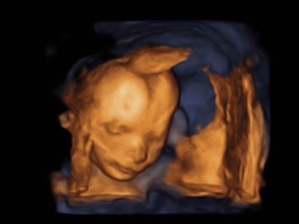 Beba ultrazvuk.jpg