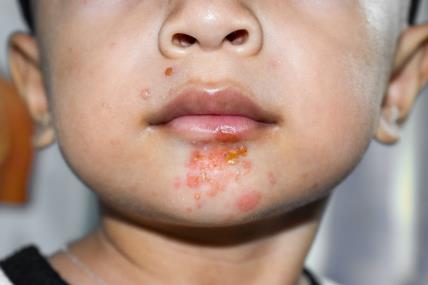Kožne bolesti kod djece i beba