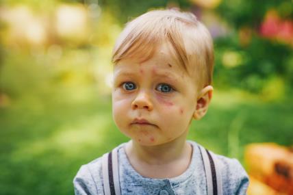 Kožne bolesti kod djece i beba