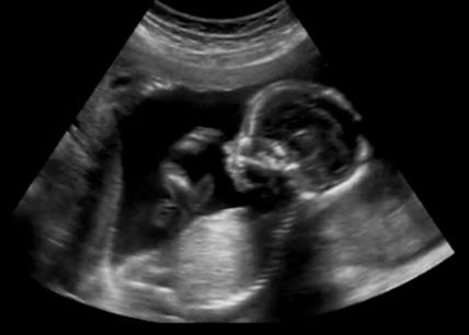 ultrazvuk bebe
