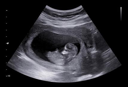 ultrazvuk u ranoj trudnoći