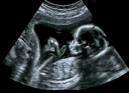 ultrazvuk bebe
