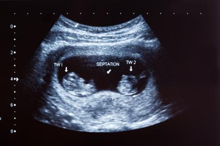 ultrazvuk blizanaca