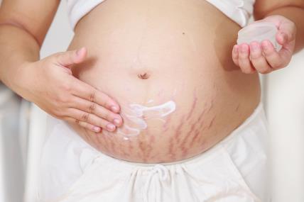 Kako spriječiti pojavu strija u trudnoći