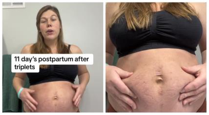 Majka pokazala kako joj izgleda trbuh nakon poroda trojki