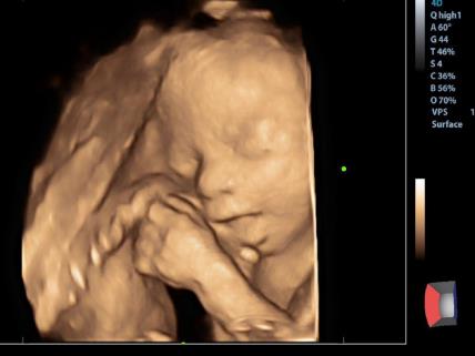 ultrazvuk beba.jpeg