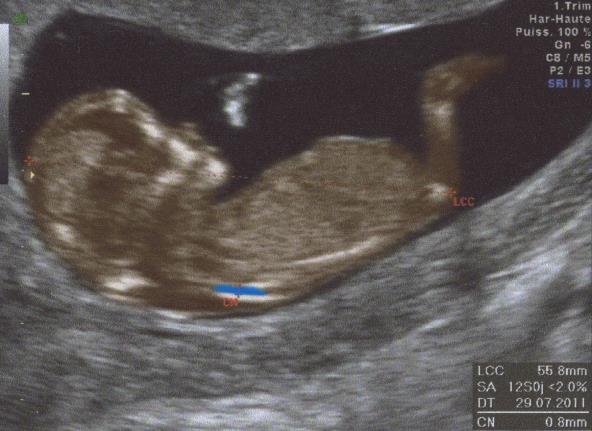 fetus u maternici